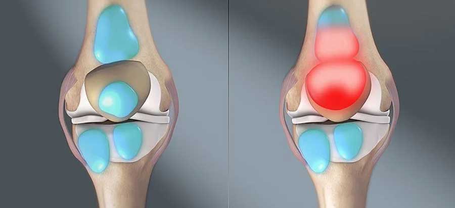 Bursitis Physiotherapy