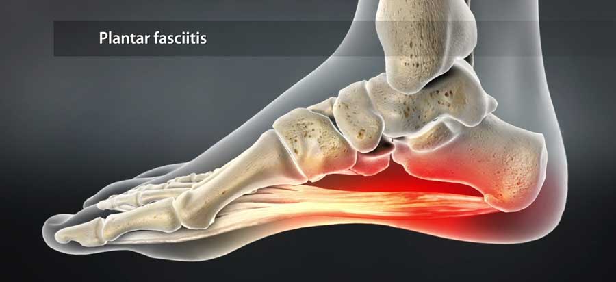 Plantar Fasciitis Physiotherapy