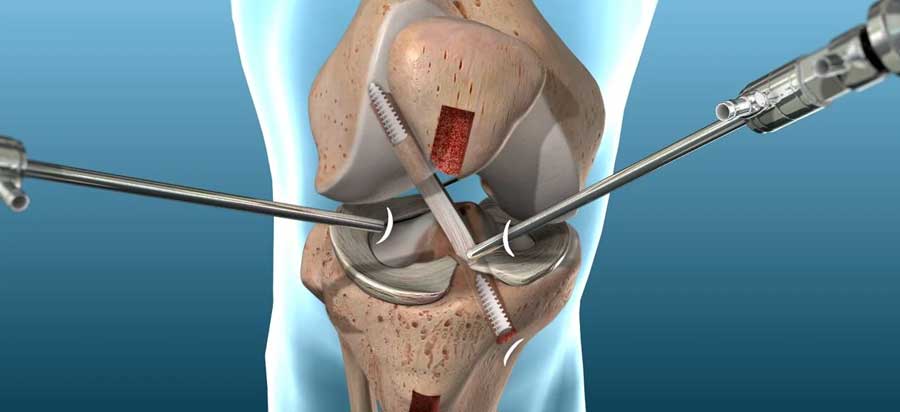 Knee Ligament Injury Physiotherapy