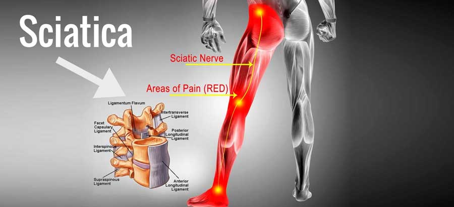 Sciatica Physiotherapy