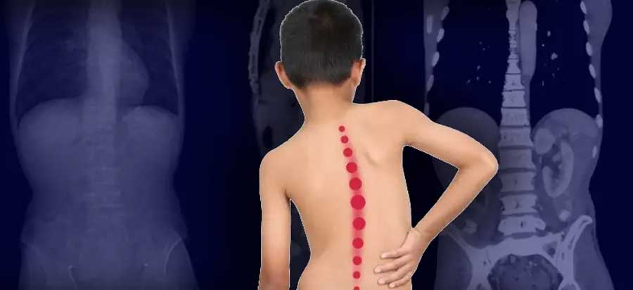 Scoliosis Physiotherapy