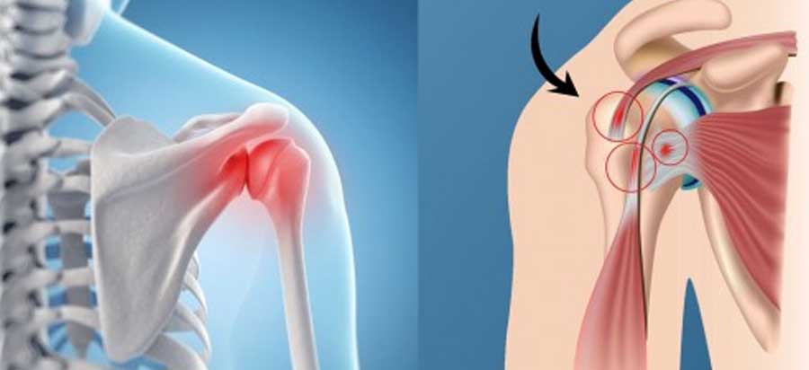 Shoulder Impingement Physiotherapy